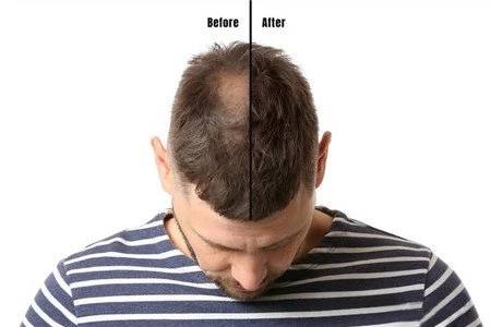 minoxidil male