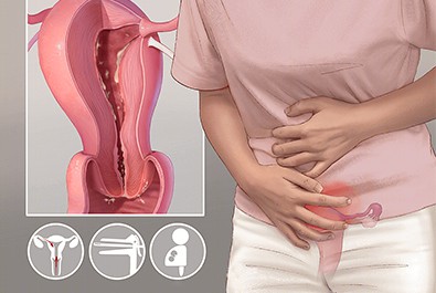 A causa da cistite frequente é revelada: você tem esses maus hábitos?